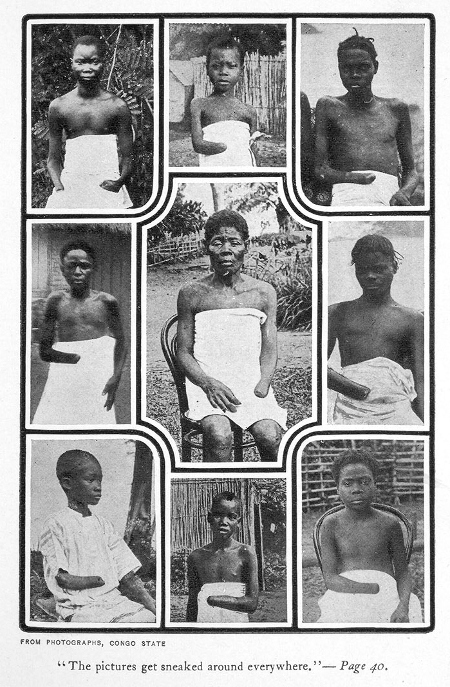 Kolonialismens grymma resultat. Kongolesiska barn, offer för Force publique i den belgiske kung Leopolds Kongo. Fotografierna är tagna 1900-1905 av Alice Seeley Harris.